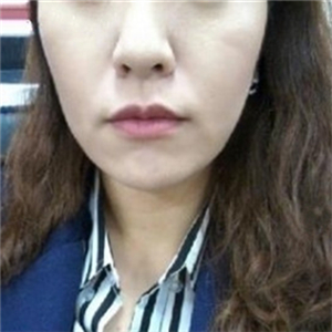 北京南加安棟顯給我做的自體脂肪去法令紋，果很好~